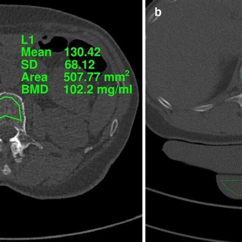 Image Example Comparing Bone Mineral Density Bmd Measurements In Download Scientific Diagram