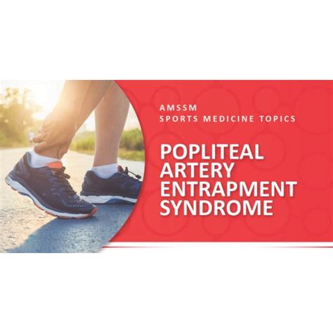 POPLITEAL ARTERY ENTRAPMENT SYNDROME | Sports Medicine Today