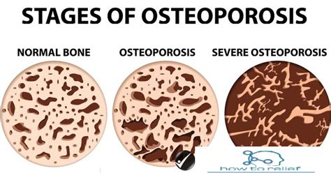 Osteoporosis Symptoms Cause Risk Factor Diagnosis Treatment