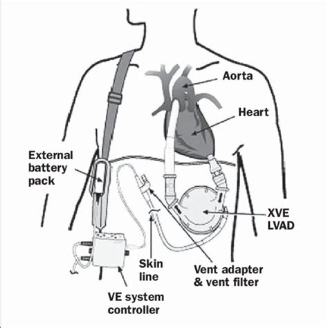 Pdf Left Ventricular Assist Device A Functional Comparison With