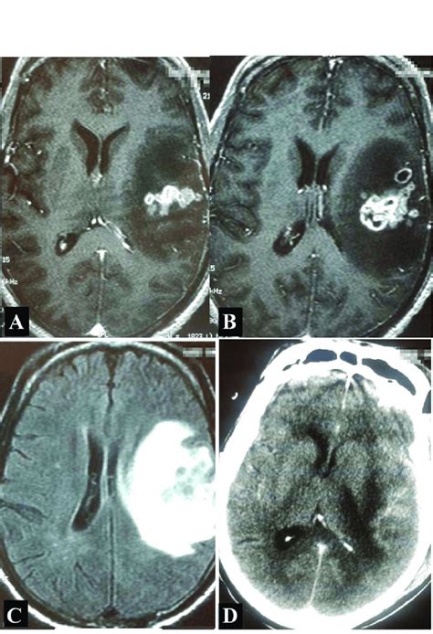 A B Magnetic Resonance Imaging Mri T1 With Contrast Demonstrating