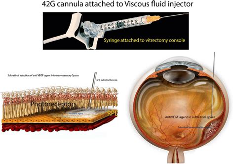 Preparation Of The Subretinal Agent Delivery System Aprepared 1 Ml