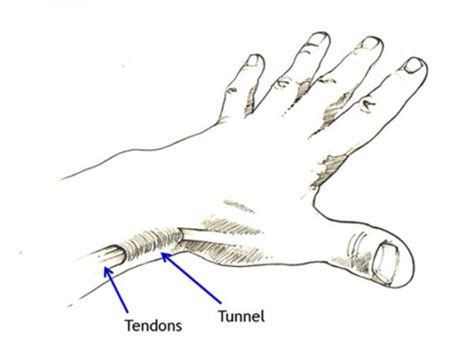 De Quervains Syndrome Gloucestershire Hand And Wrist Clinic