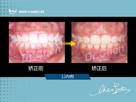 重庆牙齿矫正：〈露龈笑〉 知乎