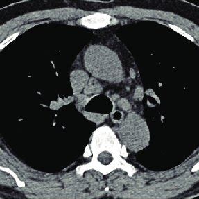 Axial View Of CT Scans Demonstrating The Mediastinal Lymphadenopathy