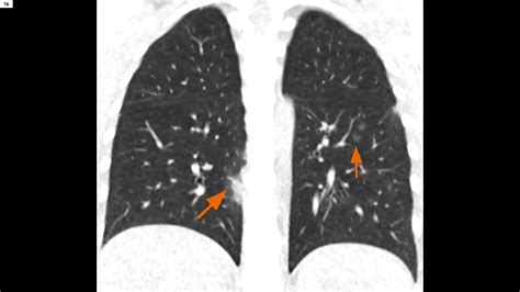 COVID-19 pneumonia – Chest X-ray or CT? - Siemens Healthineers