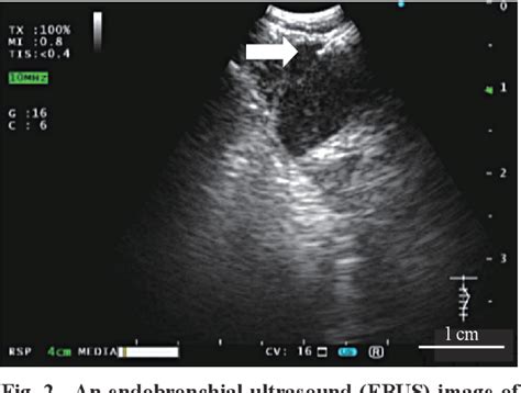 Figure From The Successful Removal Of A Broken Needle As An Unusual