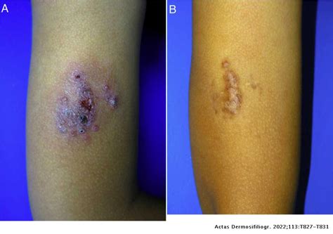 Cutaneous Leishmaniasis