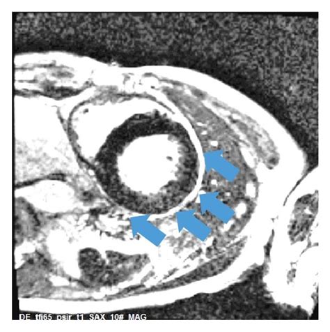 Cardiac Magnetic Resonance Imaging Confirmed Severe Left Ventricular