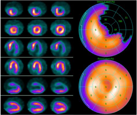 Ischemia Myocardial Perfusion