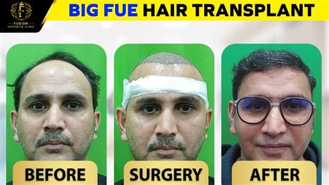 Best Hair Transplant Results Dubai Patient Hair Transplant Journey