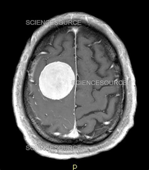 Large Meningioma on MRI | Stock Image - Science Source Images