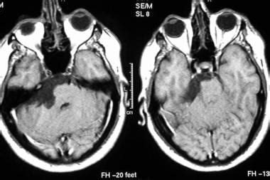 Pituitary Tumor Mri