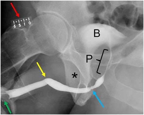 Anterior Urethral Strictures And Retrograde Urethrography An Update For Radiologists Clinical