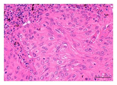 Examples Of Clca2 Immunoreactivity In Squamous Cell Carcinoma Scc And