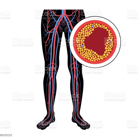 Vetores De Pad Da Doença Arterial Periférica E Mais Imagens De Anatomia