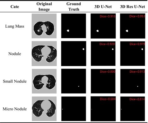 The Lung Nodule Segmentation Results Using 3D U Net And 3D Res U Net