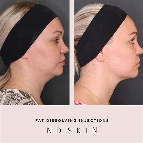 Fat Dissolving Injections Gallery Nd Skin Clinic