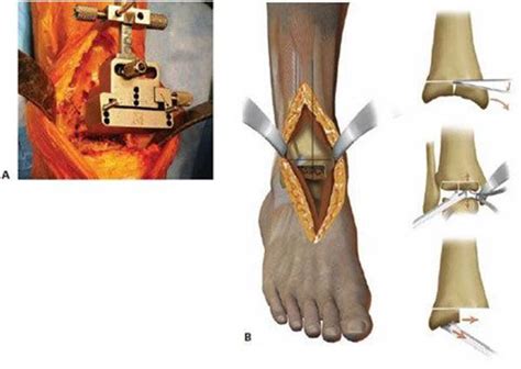 The Salto And Salto Talaris Total Ankle Arthroplasty FOOT AND ANKLE