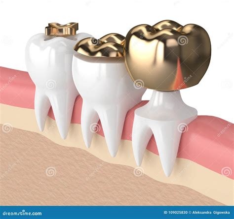 D Render Of Teeth With Different Types Of Dental Gold Filling Stock