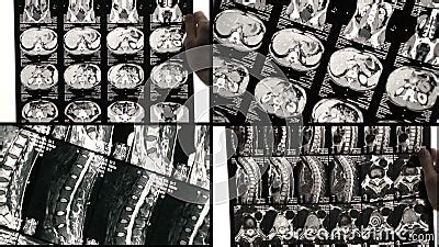 The Doctor`s See Problem Areas of the Back on the MRI Scan or X-Ray ...