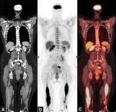 leukemia  lymphoma gleneagles hospital kuala lumpur
