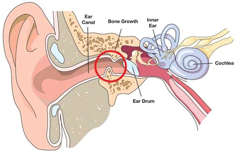 Surfer's Ear Surgery: Which Procedure Is Best?