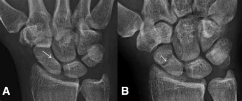 Scaphoid Fractures Teachmesurgery