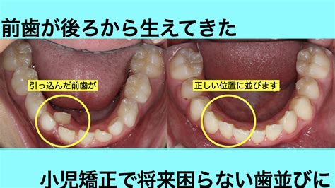 下の前歯が後ろから生えてきた小学生の歯並びを早期治療で改善した症例 茨木市の歯医者「てらい歯科クリニック」