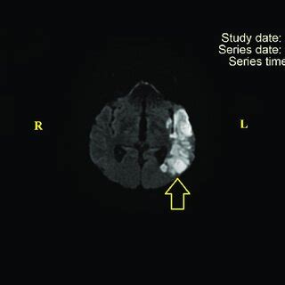 MRI in DWI. Recent ischemic stroke in superficial left MCA (indicated ...