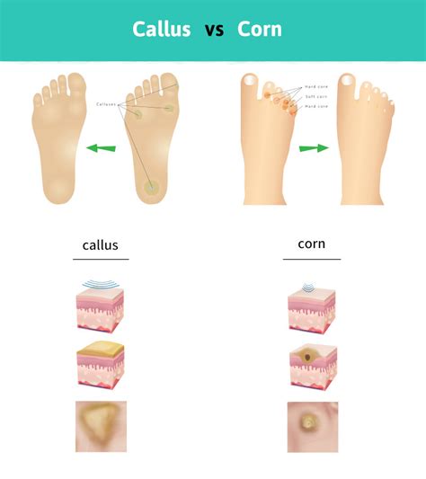 Difference Between Callus and Corn | Read This and You’ll Know