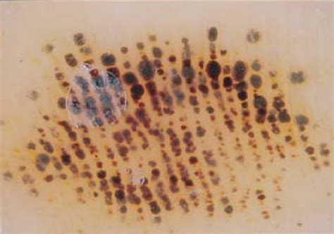 Figure 6 From Dermoscopy In The Diagnosis Of Tinea Nigra Plantaris Semantic Scholar