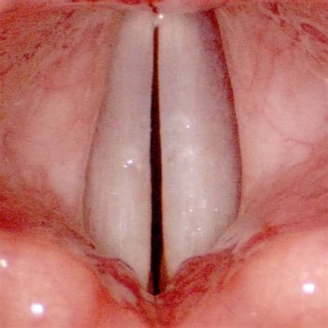 Amplificare Mostrare Cintura Porque Salen Nodulos En Las Cuerdas