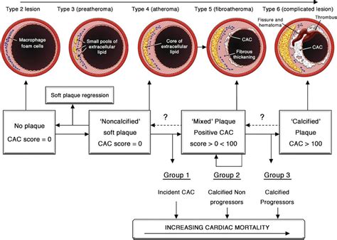 Role Of Computed Tomography For Diagnosis And Risk Stratification Of