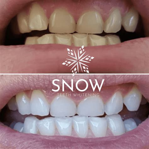 Award Winning Teeth Whitening Kit By Snow Results Guaranteed Artofit