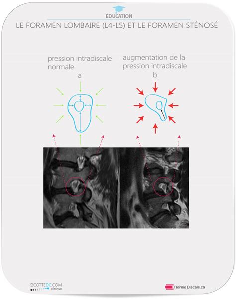 St Nose Foraminale Lombaire Sympt Mes Causes