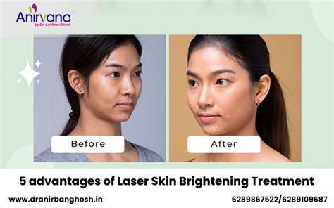 5 Advantages Of Laser Skin Brightening Treatment