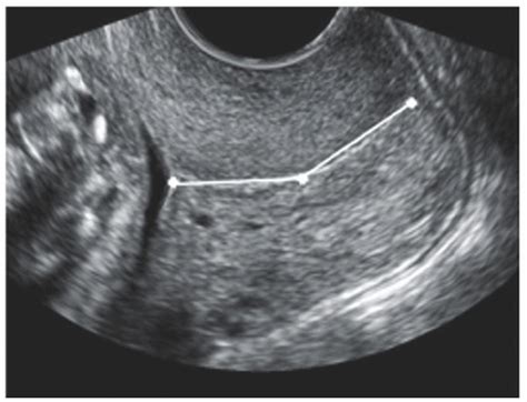 Cerclage | Obgyn Key