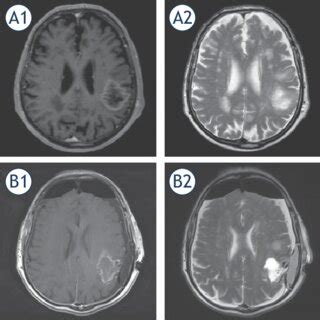 Preoperative A And Postoperative B T Weighted Contrast Enhanced