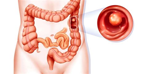Pólipo No Intestino Sintomas - Pólipos no intestino: tudo sobre sintomas e como prevenir complicações ...