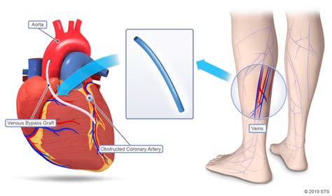 Leg Vascular Bypass Surgery Questions