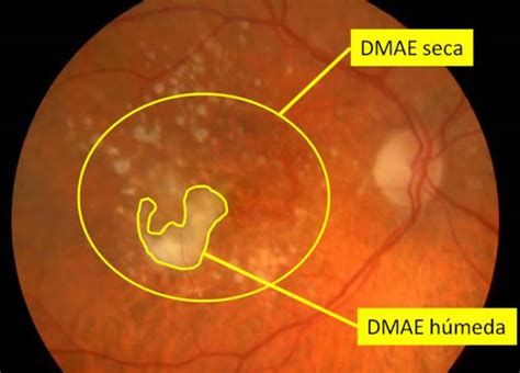 Entender La Degeneraci N Macular Asociada A La Edad Dmae En T Rminos