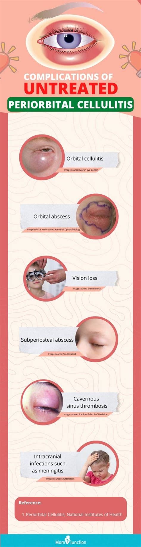 Symptoms And Causes Of Periorbital Cellulitis In Children