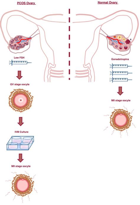 In Vitro Maturation Of Oocytes As A Laboratory Approach To Polycystic