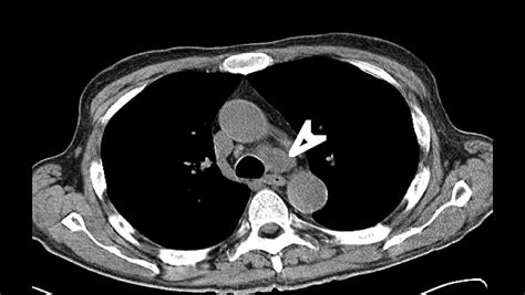 American Thoracic Society Suspicion Of Lung Cancer With Nodal