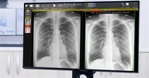 Ai Radiology Tool Supports Real Time Diagnosis Of Covid Related