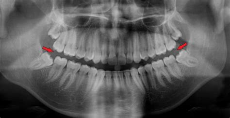 Ortopantomografia OPG O Radiografia Panoramica Quali Errori Evitare