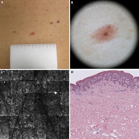 Table 1 From Dermoscopic Histological Confocal Microscopy Correlation