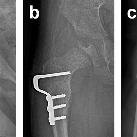 A Preoperative Anteroposterior Ap Radiograph Showing A Subluxated Download Scientific