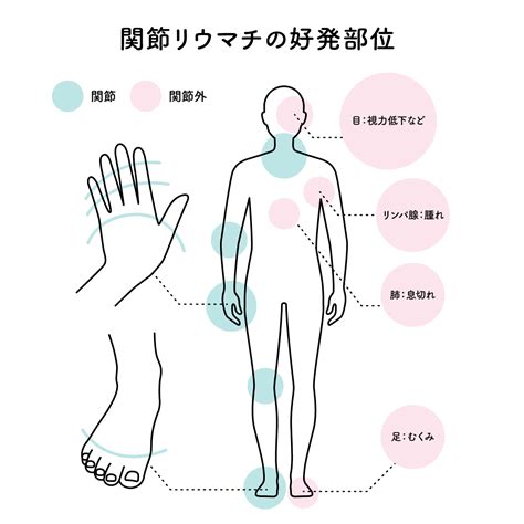 働き盛りの女性に多い関節リュウマチについて・・・予防策は！ 【大阪口臭センター ・ほんだ歯科口臭外来部】dr 本田のブログ～口臭症治療・ドライマウス・アンチエイジング～